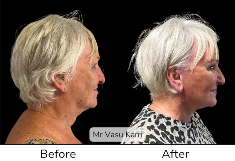 Facelift Patient 4 View 2